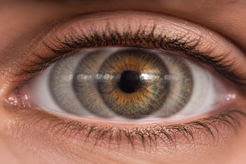 nystagmus